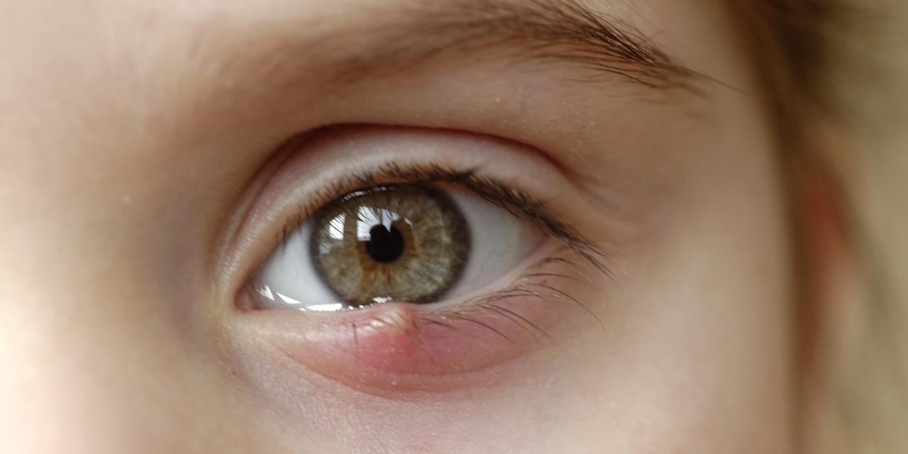 The most common eye infections
